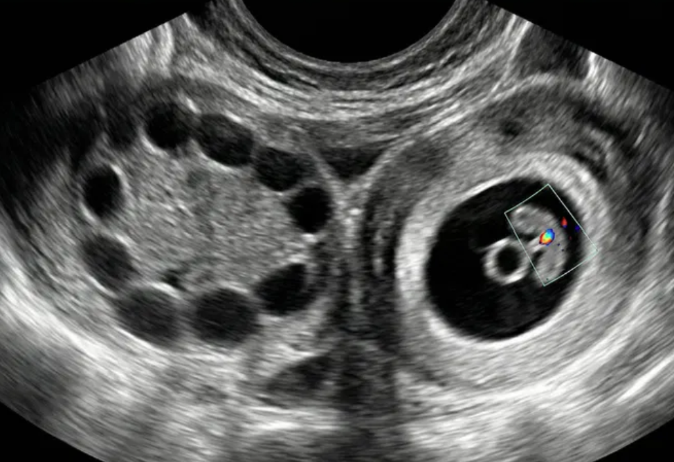 Gestação ectópica tubária com saco gestacional e embrião.