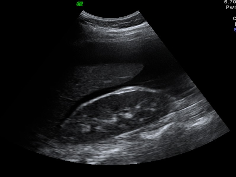 Ultrassom mostrando líquido livre em grande quantidade na pelve, compatível com ascite/hemoperitônio