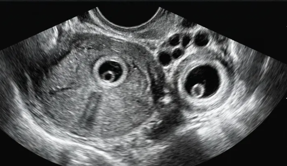 Exemplo ilustrativo relacionado à avaliação de gestação heterotópica (útero e anexos).