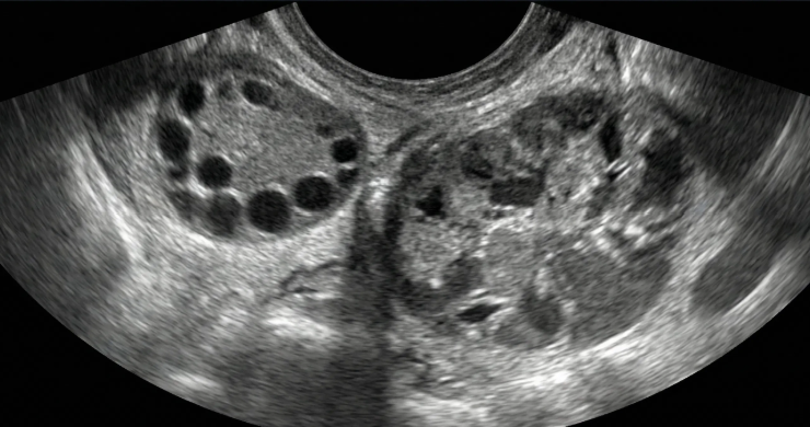 Massa anexial complexa e heterogênea, separada do ovário.