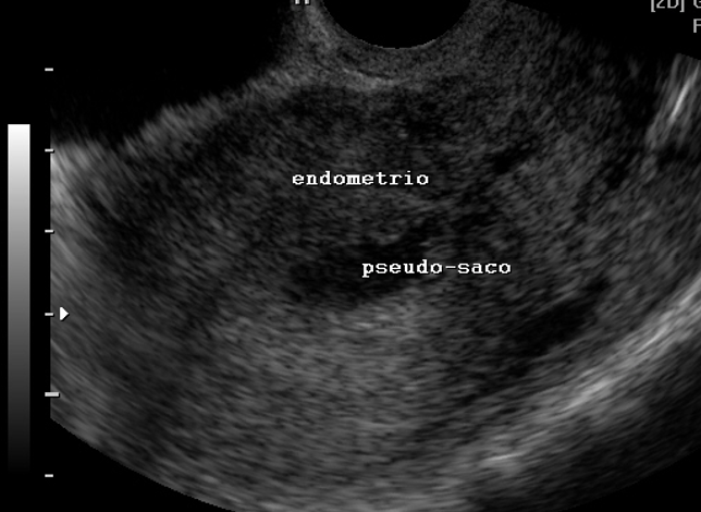 Pseudo-saco: líquido na cavidade uterina, simulando saco gestacional.
