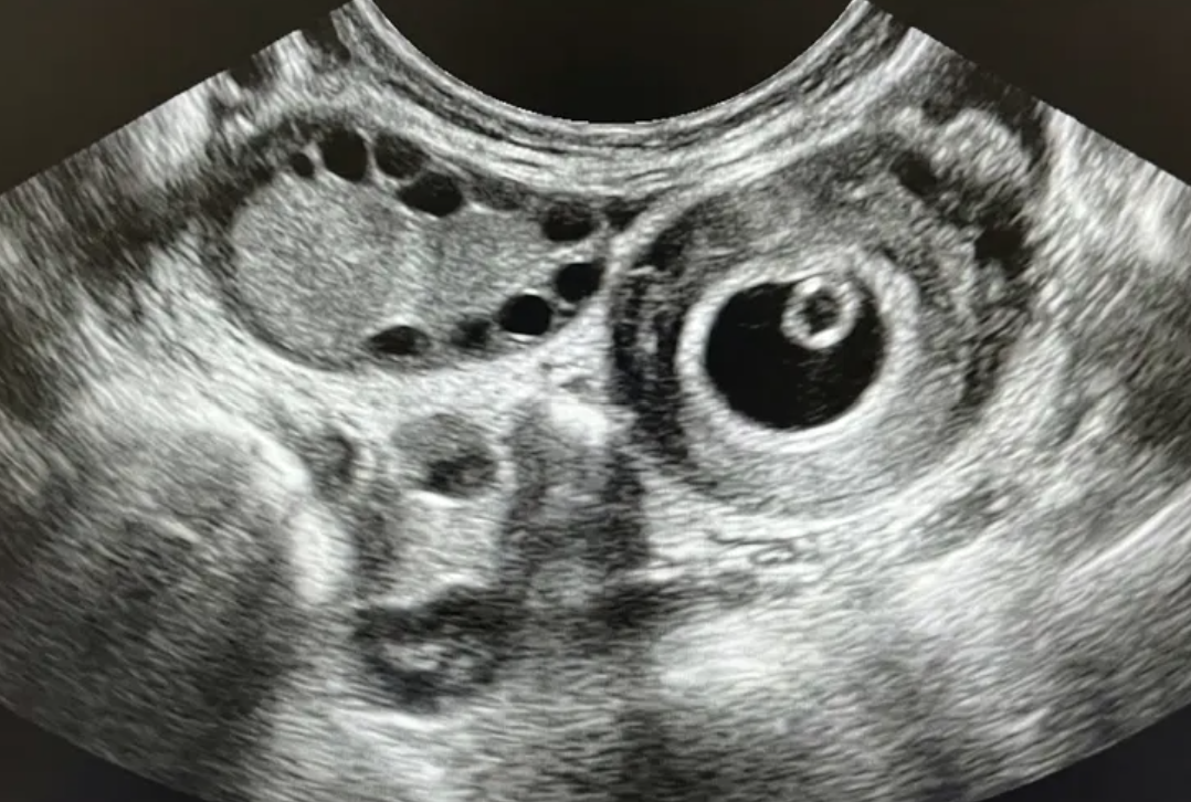 Massa anexial separada do ovário com saco gestacional e vesícula vitelínica (sinal do deslizamento).