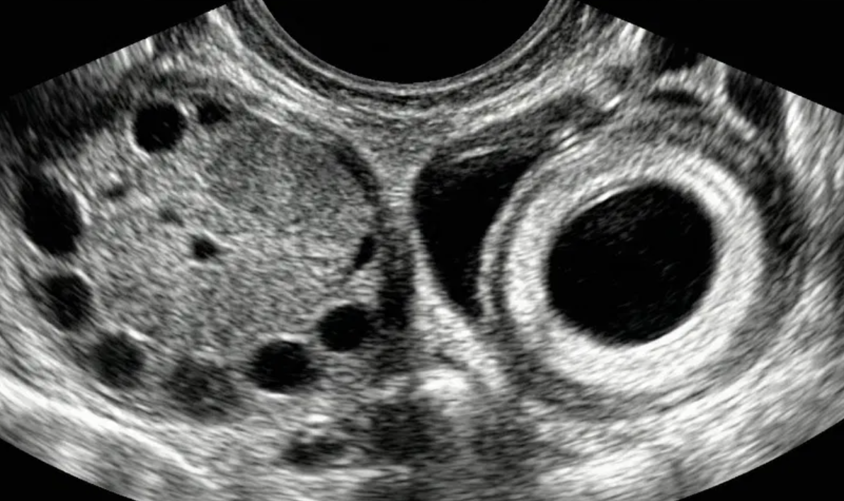 Saco gestacional vazio em massa anexial separada do ovário (tubal ring/bagel sign).