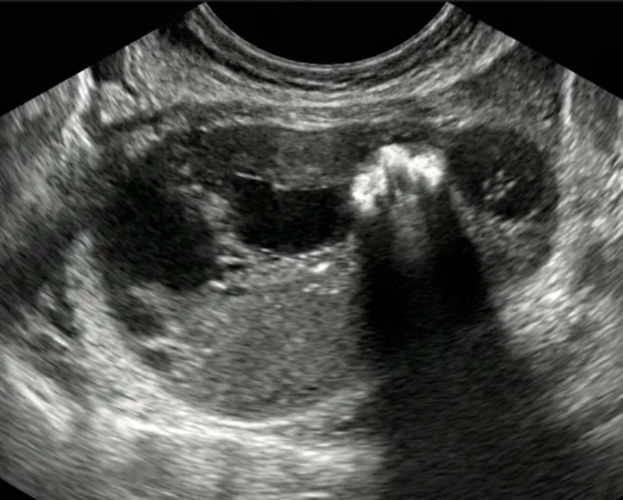 Ultrassom mostrando massa com áreas hiperecogênicas e sombras acústicas posteriores