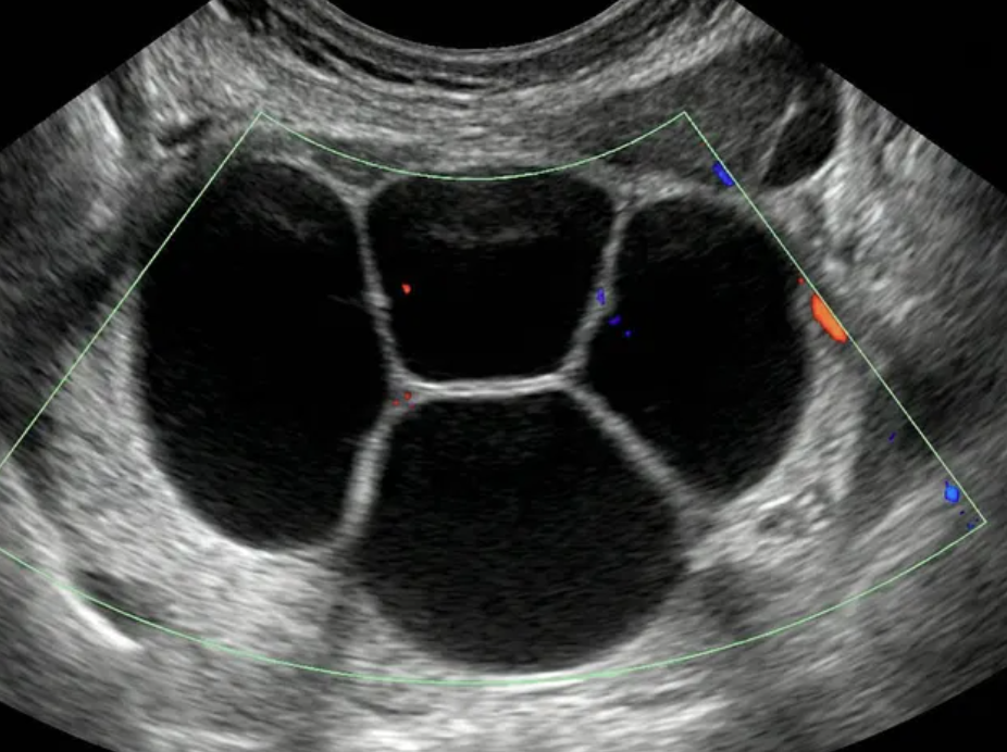 Ultrassom mostrando tumor multilocular com múltiplas câmaras bem definidas e paredes lisas
