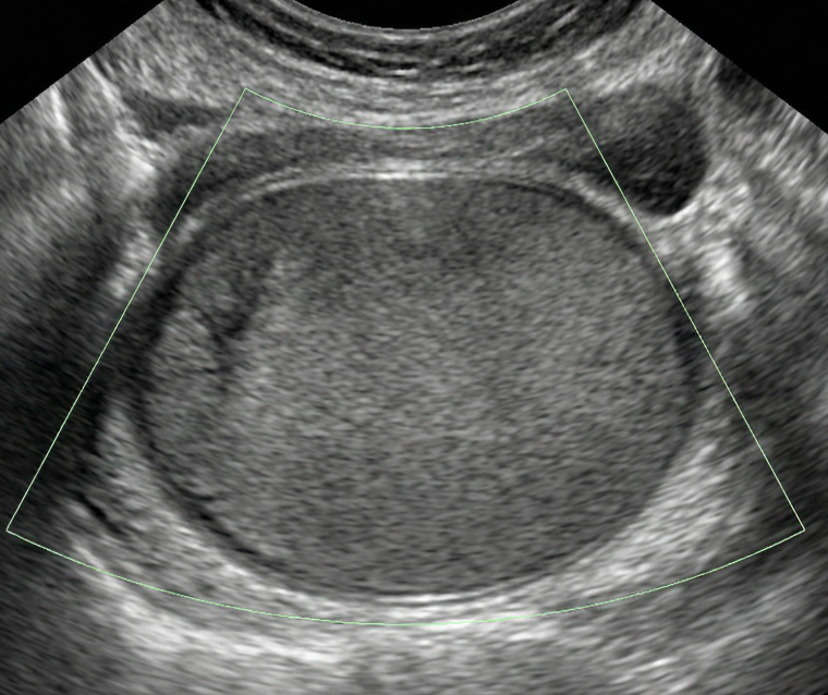 Doppler colorido mostrando massa com ausência ou fluxo sanguíneo mínimo