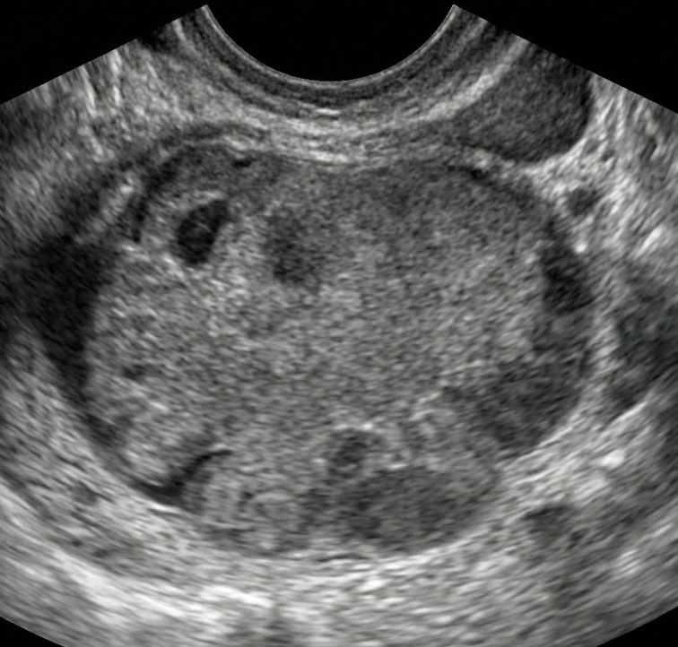 Ultrassom mostrando tumor predominantemente sólido com bordas irregulares e ecotextura heterogênea