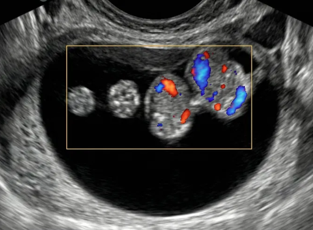 Ultrassom mostrando massa cística com múltiplas estruturas papilares sólidas projetando-se para o lúmen