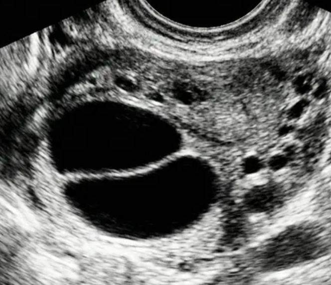 Ilustração: Cisto unilocular, liso não simples (ecos internos e / ou septações incompletas) ou cisto bilocular liso ≤3 cm