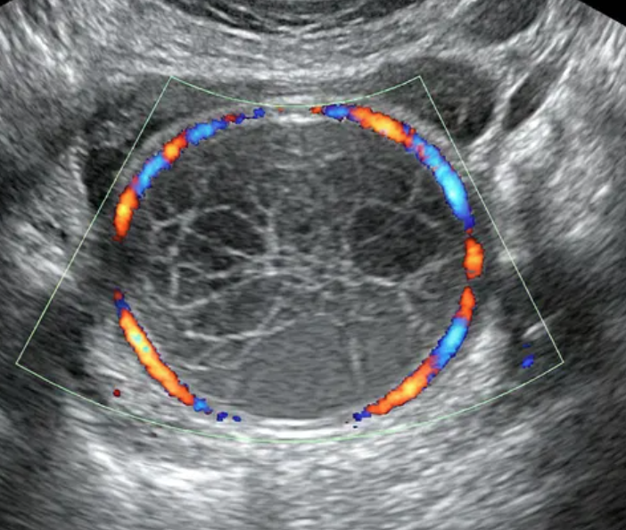 Ilustração: Cisto hemorrágico típico ≤ 5 cm
