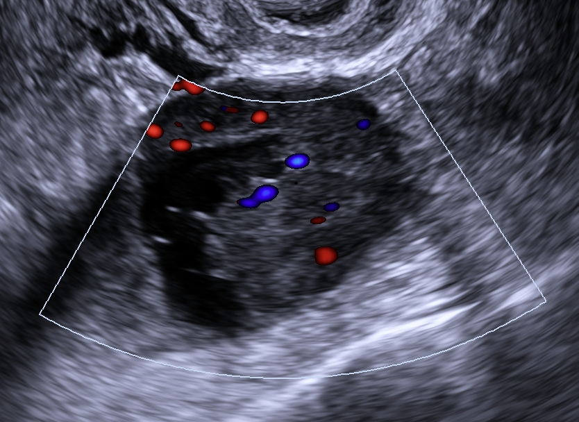 Ilustração: Cisto multilocular com componente sólido, qualquer tamanho, IC = 1–2
