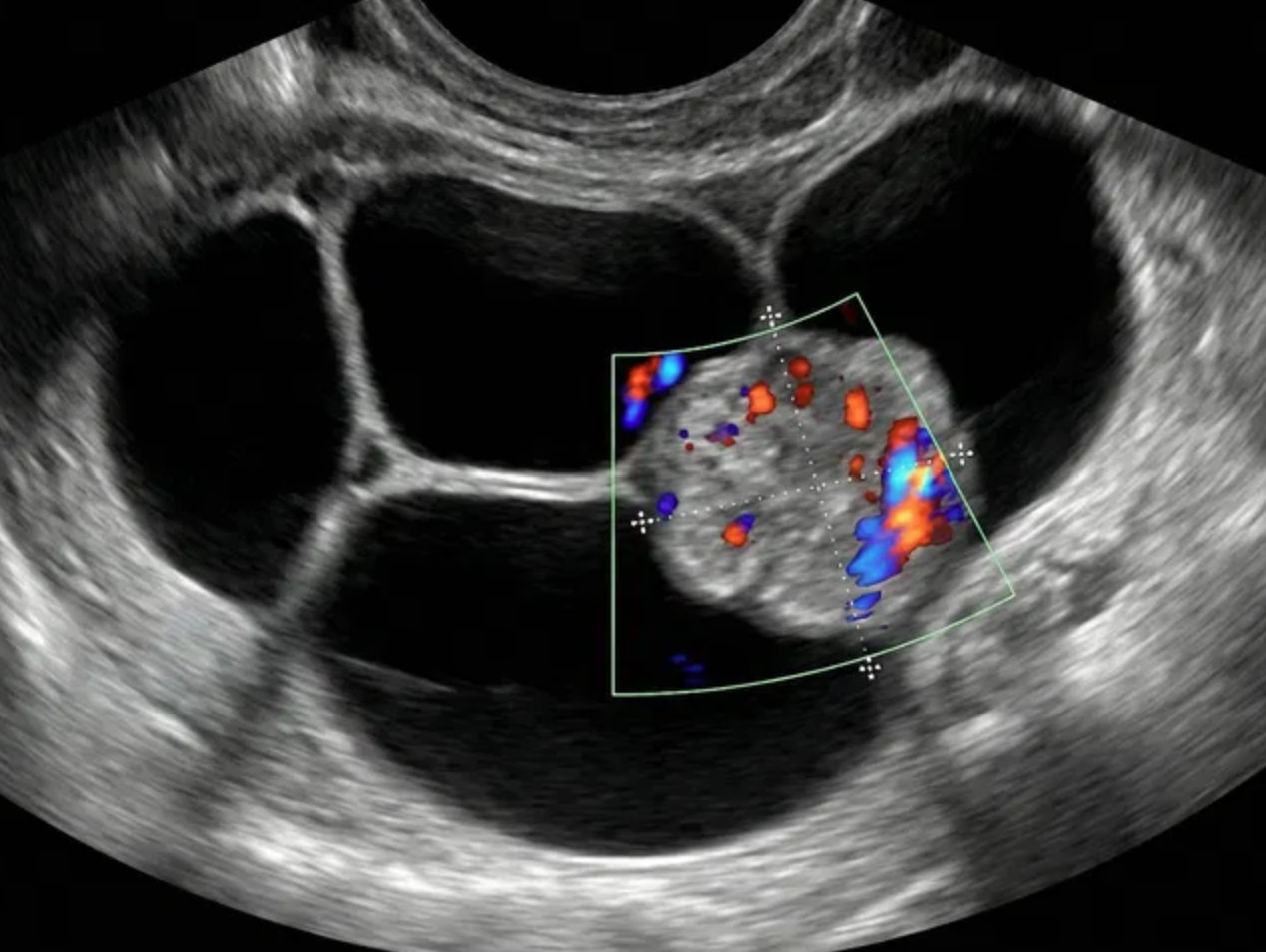 Ilustração: Cisto multilocular com componente sólido, qualquer tamanho, IC = 3–4