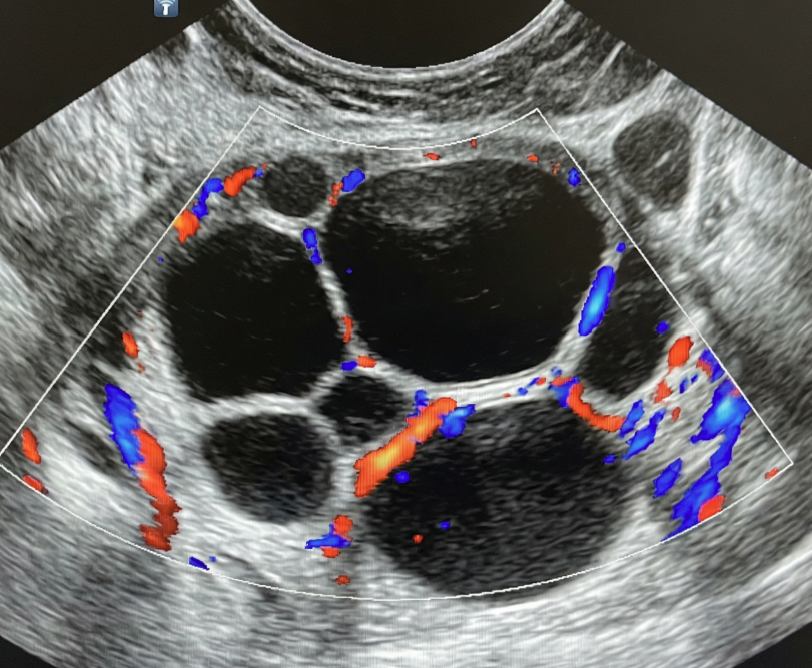 Ilustração: Cisto multilocular, sem componente sólido: ≥ 10 cm, parede interna lisa, IC = 1–3