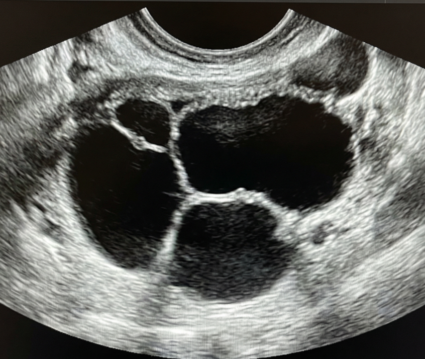 Ilustração: Cisto multilocular, sem componente sólido: qualquer tamanho, septação irregular, qualquer IC