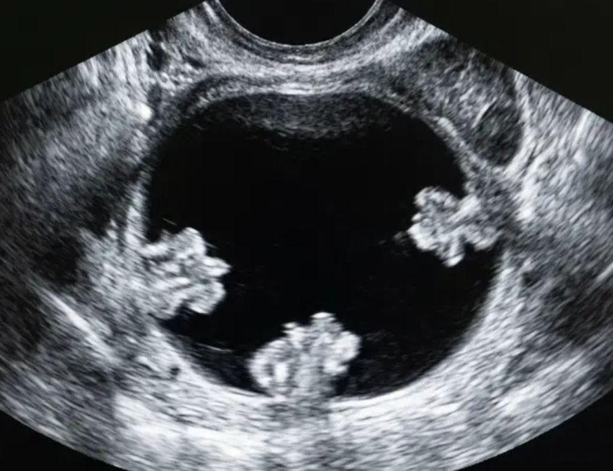 Ilustração: Cisto unilocular com 0–3 projeções papilares, qualquer IC