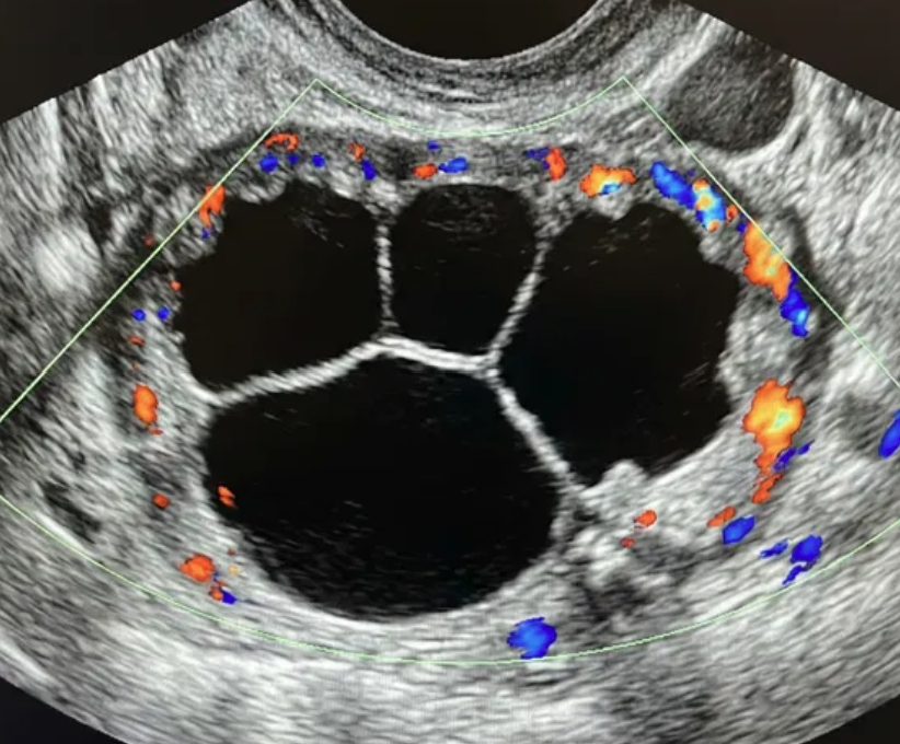 Ilustração: Cisto multilocular, sem componente sólido: qualquer tamanho, parede interna irregular, qualquer IC