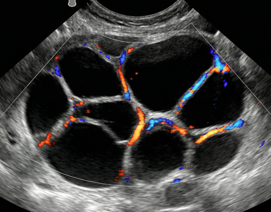 Ilustração: Cisto multilocular, sem componente sólido: qualquer tamanho, parede interna lisa, IC = 4