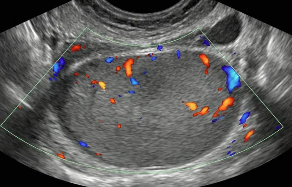 Ilustração: Lesão sólida, superfície lisa, qualquer tamanho, IC = 2–3