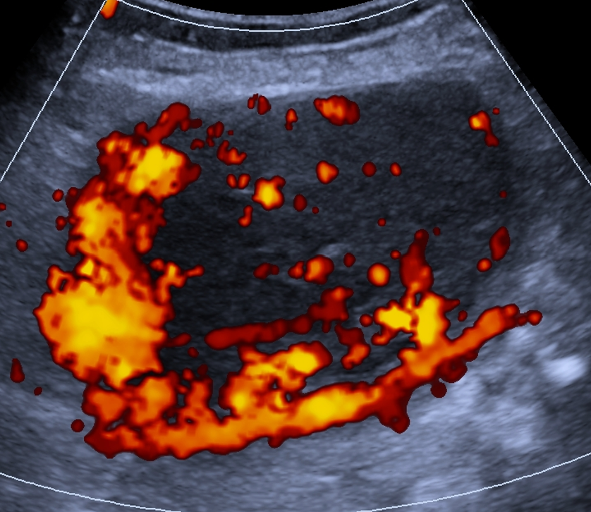 Ilustração: Lesão sólida com superfície lisa, qualquer tamanho, IC = 4