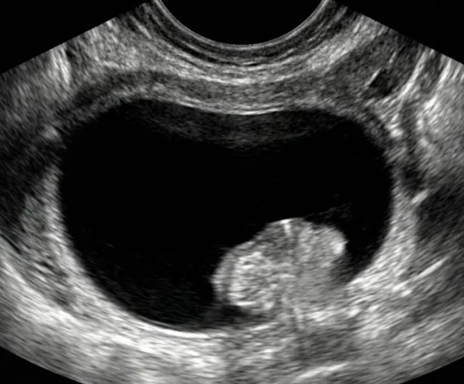 Ilustração: Cisto unilocular com componente sólido, qualquer tamanho, qualquer IC