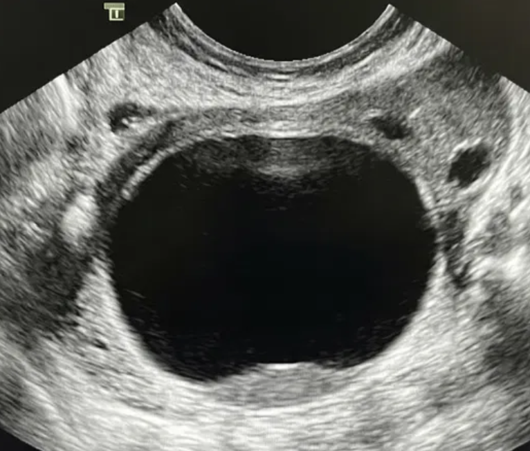 Ilustração: Cisto unilocular de qualquer tamanho com parede interna irregular < 3 mm de altura