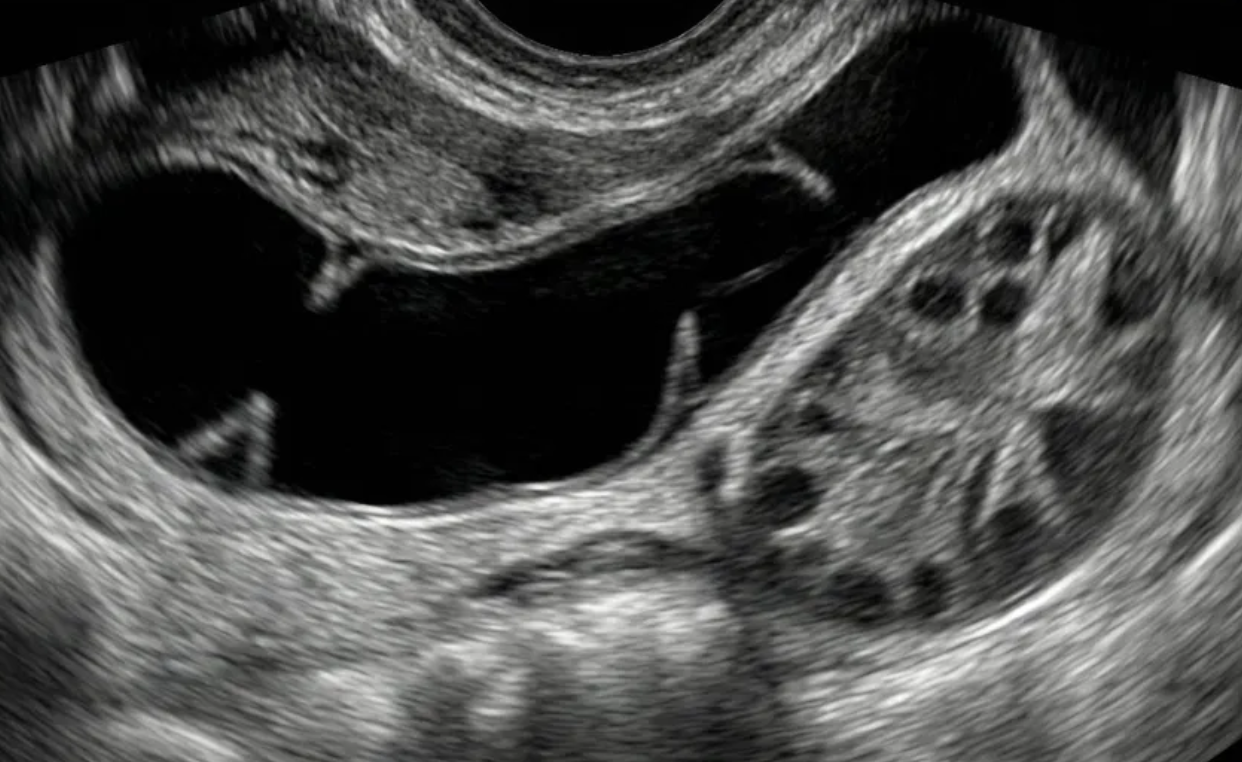 Ilustração: Hidrossalpinge típica de qualquer tamanho