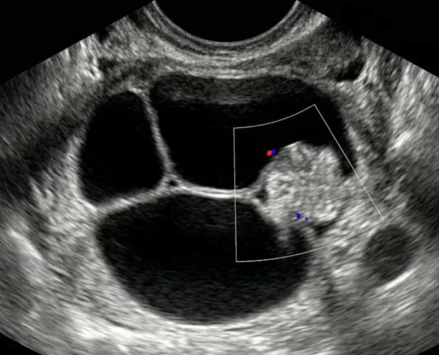 Ilustração: Cisto multilocular com componente sólido, qualquer tamanho, IC = 1–2