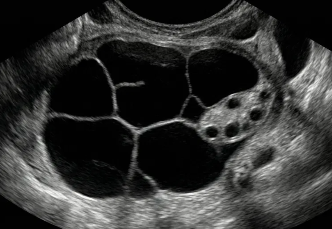 Ilustração: Cisto de inclusão peritoneal de qualquer tamanho