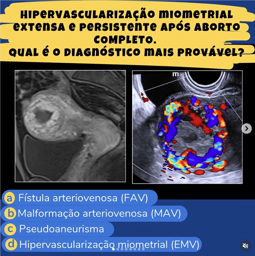 Hipervascularização miometrial extensa e persistente após aborto completo.