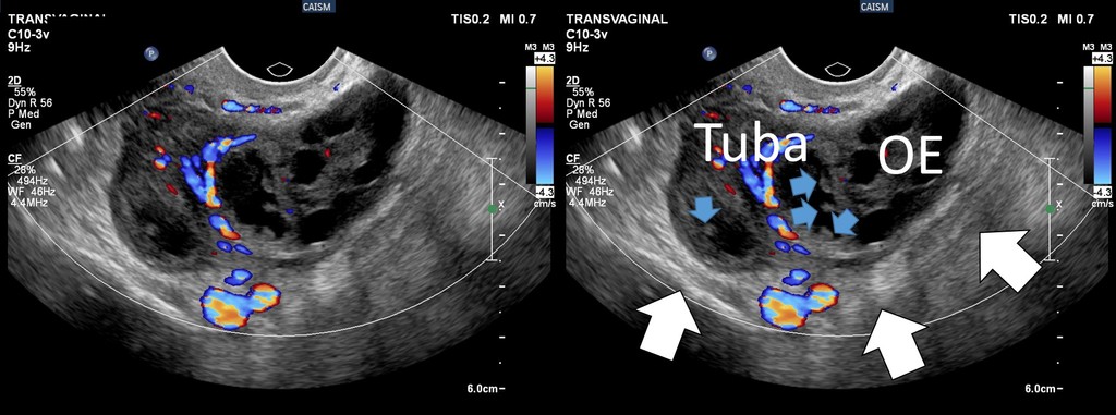 Sinais de ooforite pela ultrassonografia Dr Pixel