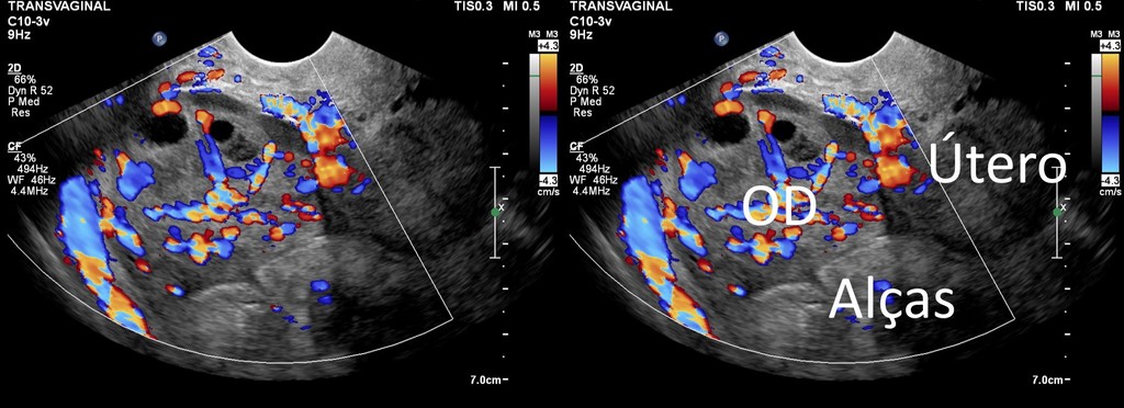 Ooforite ou ovarite: causas, sintomas, diagnóstico e tratamento - Saúde da  Mulher > AbcMed